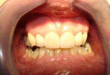 veneers after.JPG